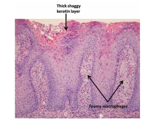 Abnormal Lesion