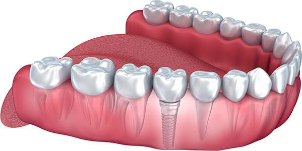 Dental Implant