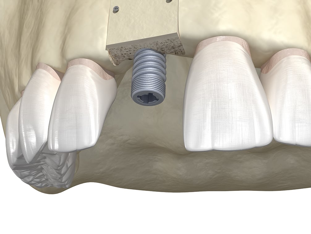 Bone grafting illustration