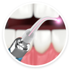 Laser Periodontics